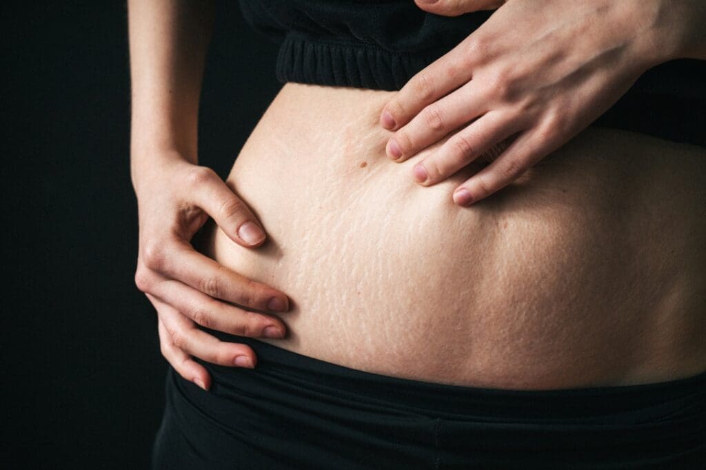 Close-up of female showing stretch marks. Women body after childbirth. Body recovery and care.