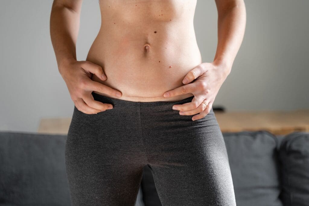 Woman with c section scar on her abdomen